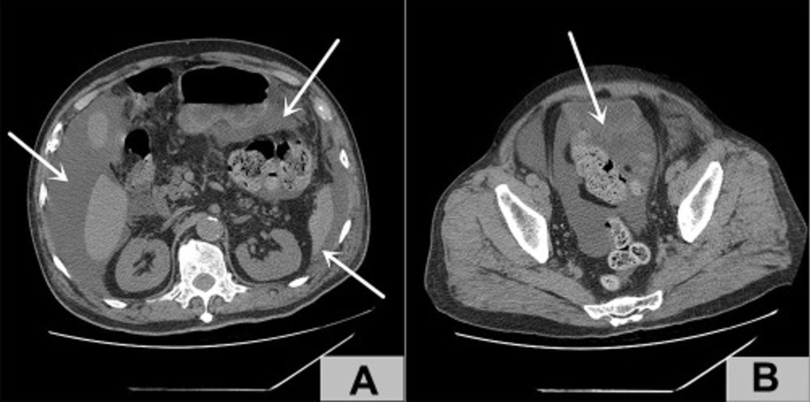 Medical Case - Guertelrose -..